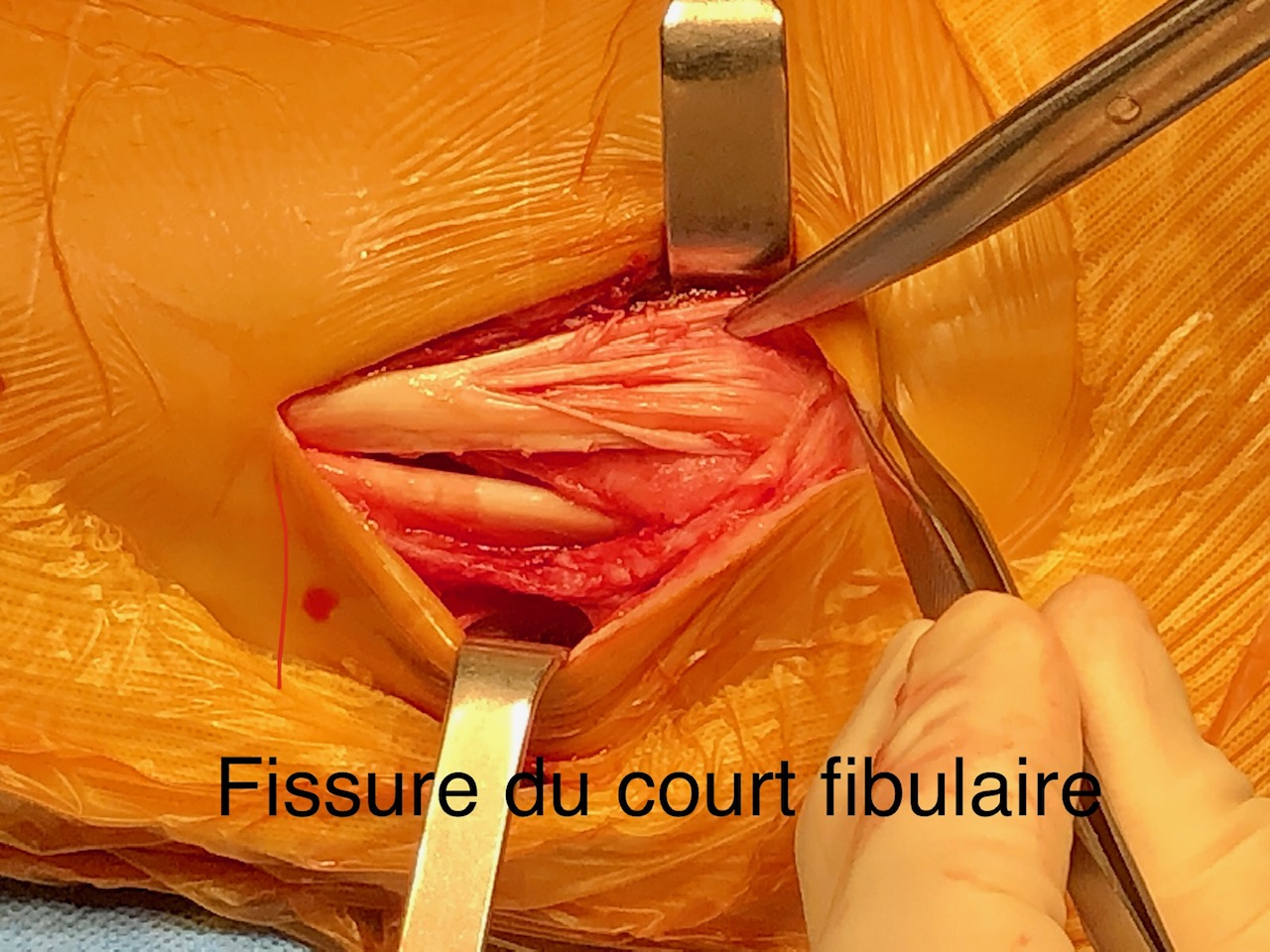 Syndrome Fissuraire Du Tendon Court Fibulaire Traitement