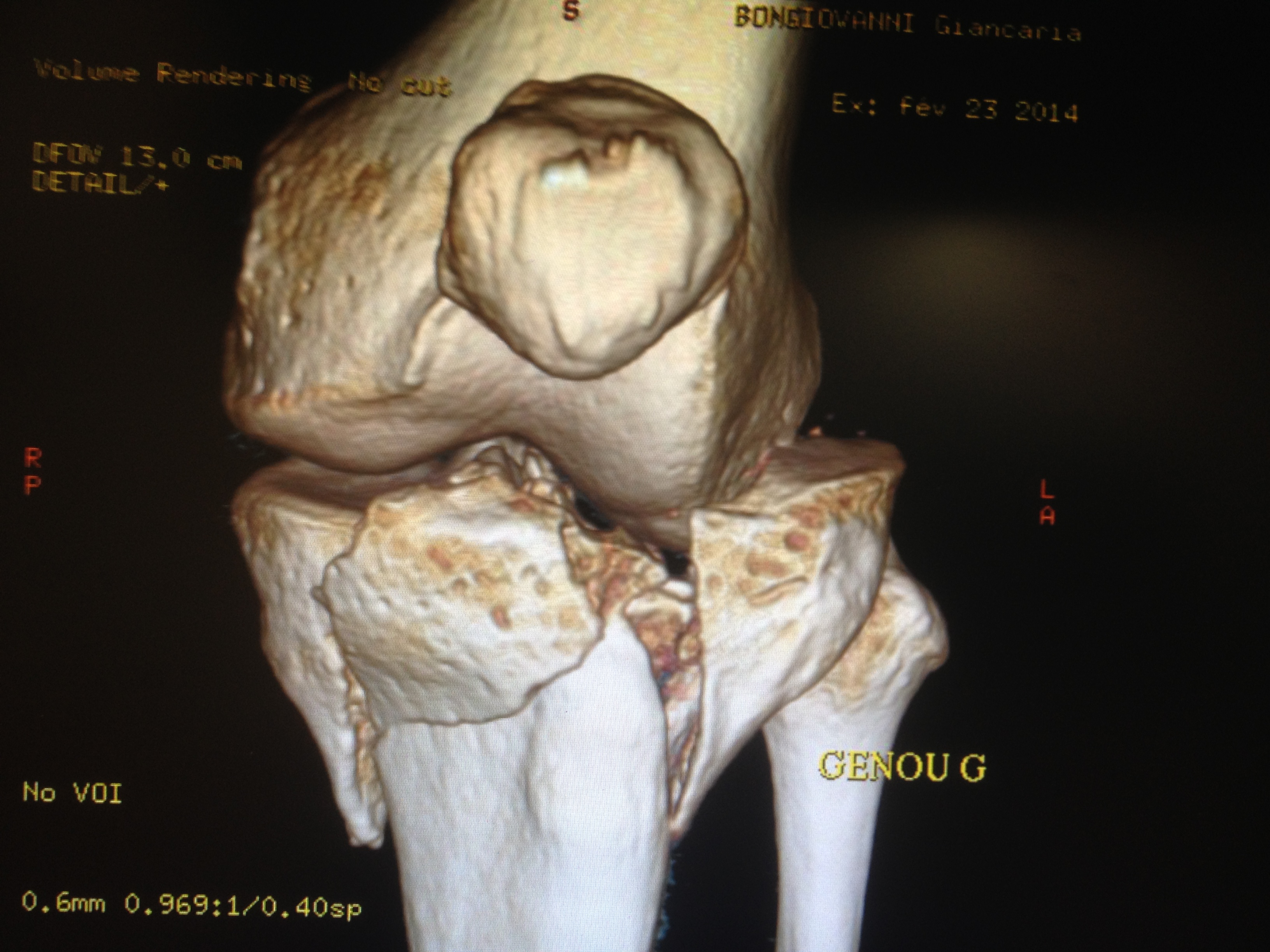 Fracture grave des plateaux tibiaux