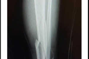 Fractures de jambe
