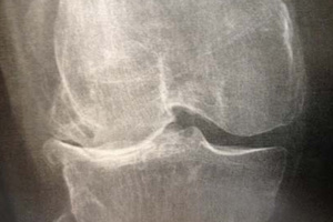 Arthrose en miroir